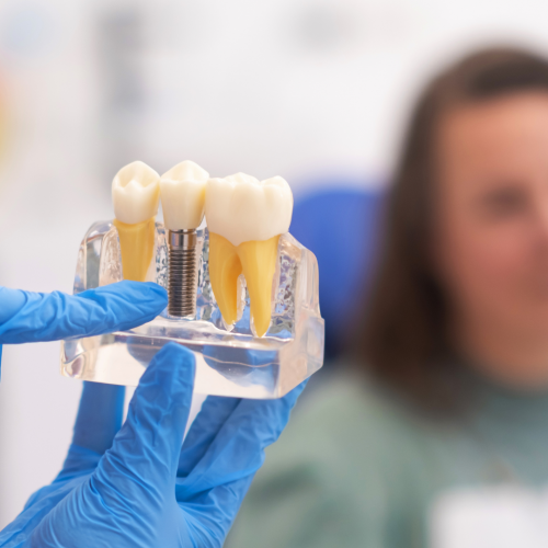 Comprendre l'Implantologie Dentaire