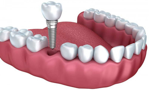 Couronne et implant : Qu'elle différence ?