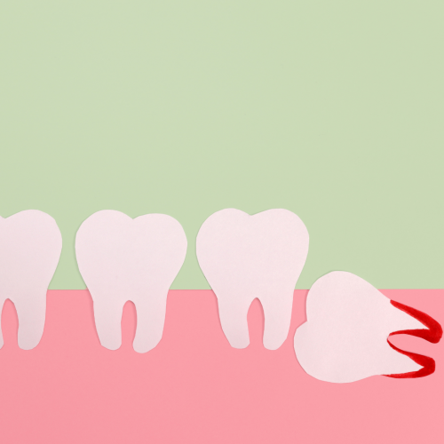 Dents de sagesse : faut-il toujours les extraire ?