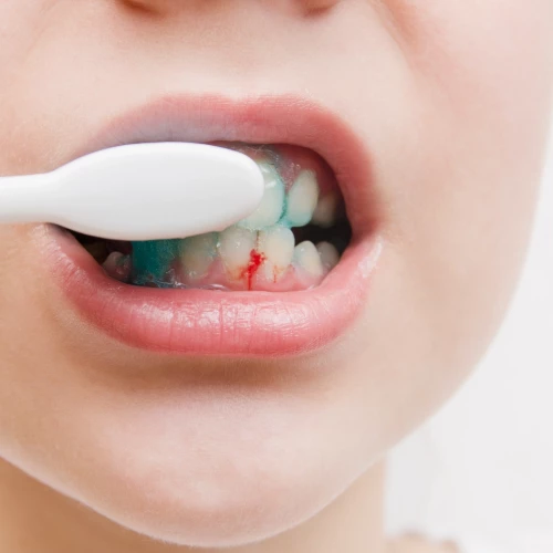 Gencives qui saignent : est-ce normal et quand faut-il s&rsquo;inqui&eacute;ter ?