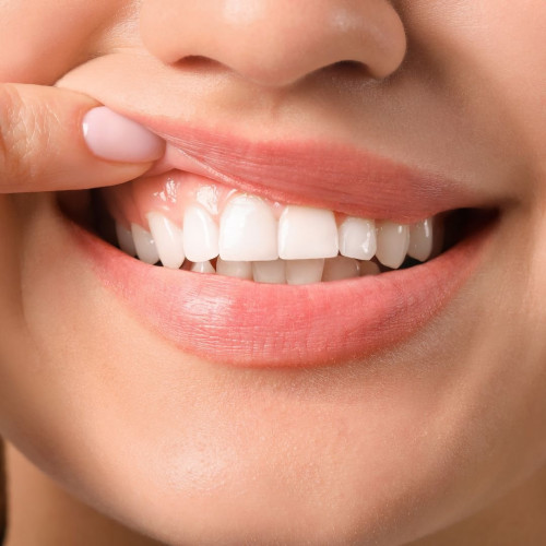 Greffes gingivales