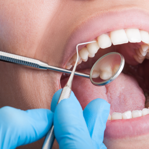 Le d&eacute;tartrage ab&icirc;me-t-il les dents ? V&eacute;rit&eacute;s et id&eacute;es re&ccedil;ues