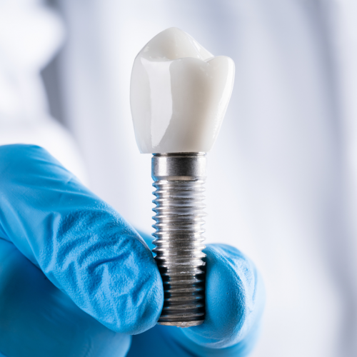 Les 5 questions les plus fréquentes sur les implants dentaires