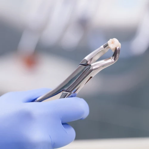 Les erreurs &agrave; &eacute;viter apr&egrave;s une extraction dentaire