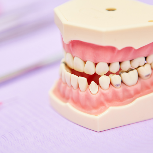 Malocclusion dentaire : D'où vient-elle et comment la corriger ? 