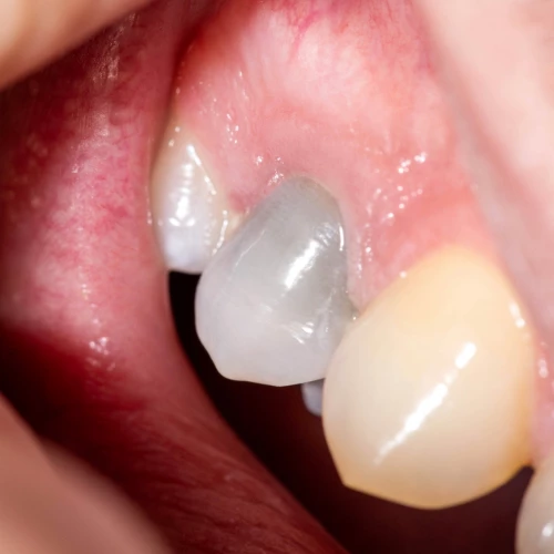Pourquoi une dent devient-elle grise ou noire ?