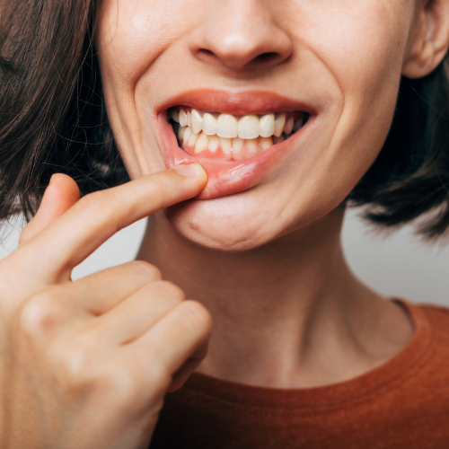 R&eacute;cession gingivale : pourquoi mes gencives se r&eacute;tractent ? 